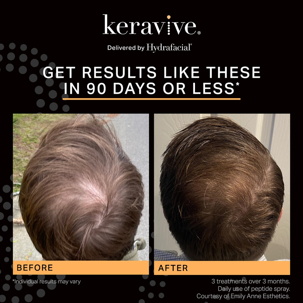 Hydrafacial Keravive Tips Yellow (15 kpl) - pakkaus